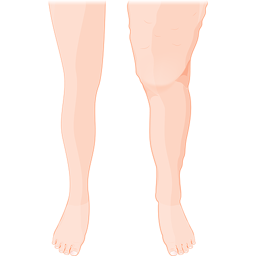Lipoedema