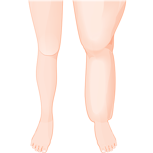 Lymphoedema