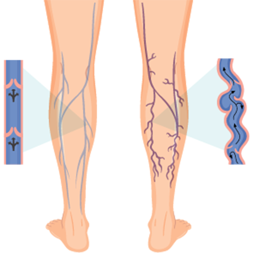 Varicose veins