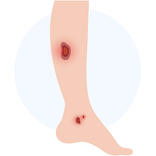 Venous leg ulcer